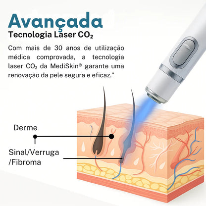 Mediskin Laser Pen