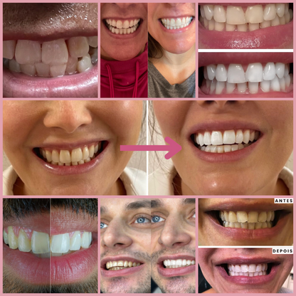 BodyAccel Pasta Branqueadora Natural – Fórmula Suave com Niacinamida